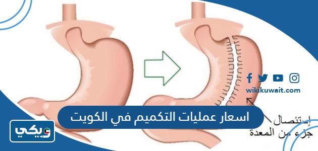 اسعار عمليات التكميم في الكويت