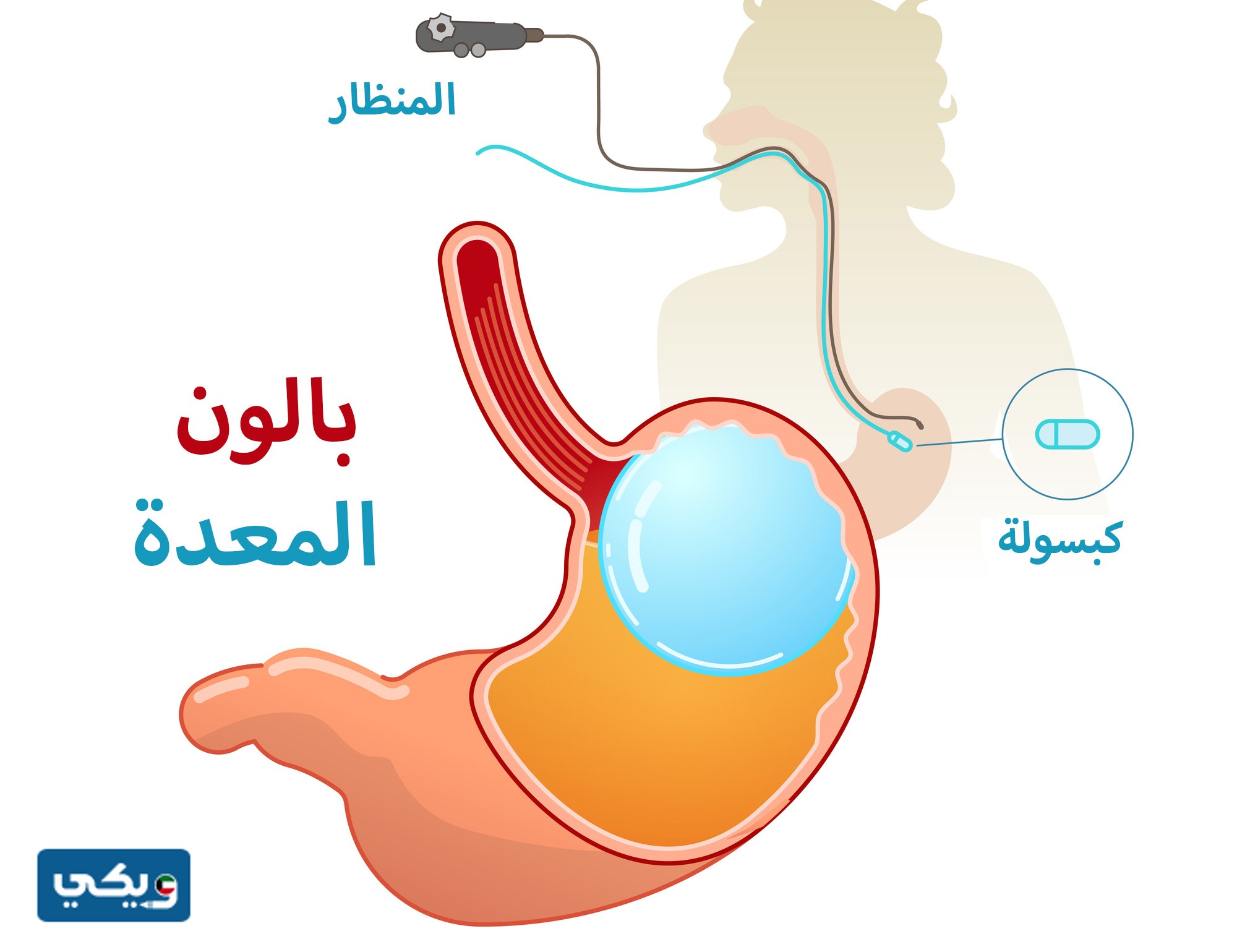 الكبسولة الذكية للتخسيس