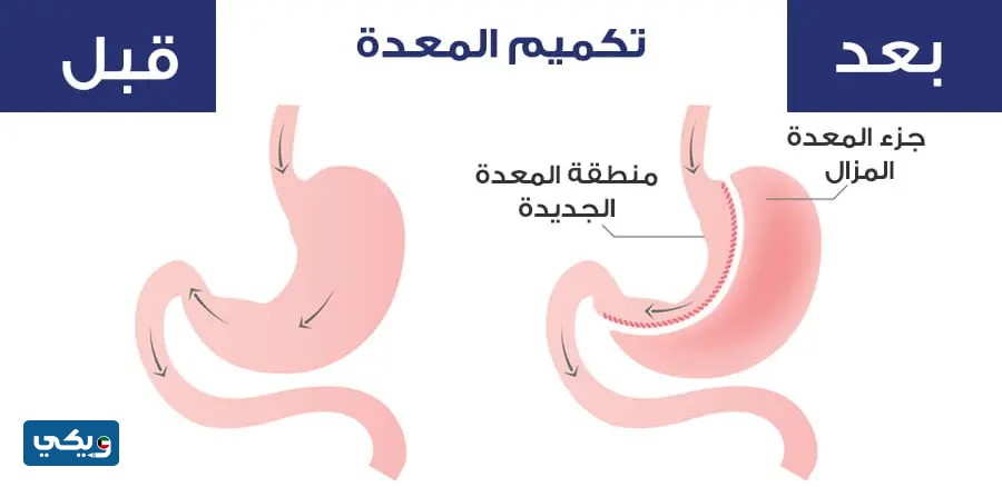 عملية تكميم المعدة