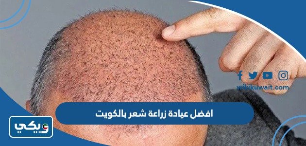 افضل عيادة زراعة شعر بالكويت