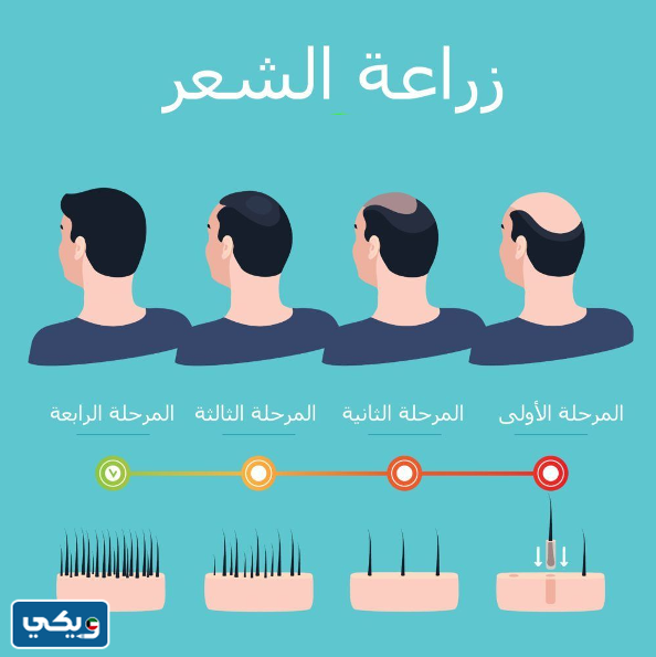 تجارب زراعة الشعر الإيجابية في الكويت