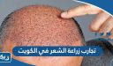 تجارب زراعة الشعر في الكويت