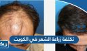 تكلفة زراعة الشعر في الكويت