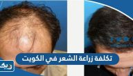 كم تكلفة زراعة الشعر في الكويت 2025 كم تكلفة زراعة الشعر في الكويت 2025