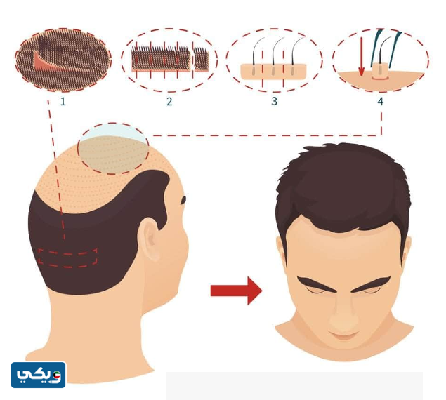 تكلفة زراعة الشعر في الكويت