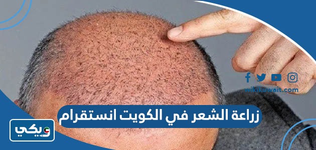 زراعة الشعر في الكويت انستقرام