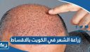 زراعة الشعر في الكويت بالاقساط