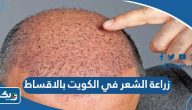 مراكز وعيادات زراعة الشعر في الكويت بالاقساط 2025 مراكز وعيادات زراعة الشعر في الكويت بالاقساط 2025