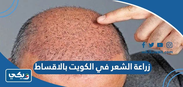 زراعة الشعر في الكويت بالاقساط