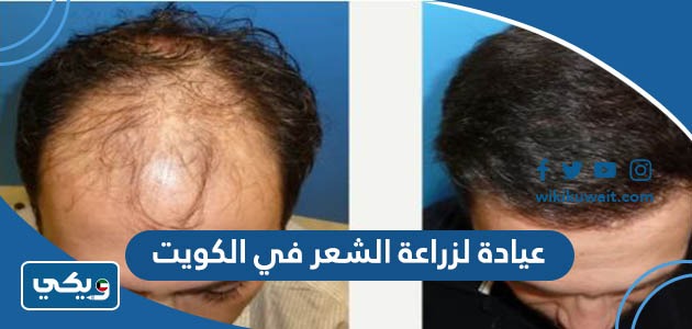 عيادة لزراعة الشعر في الكويت