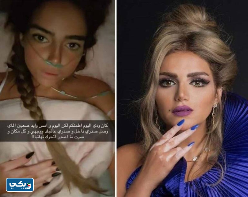 ما هو مرض غدير البرجس