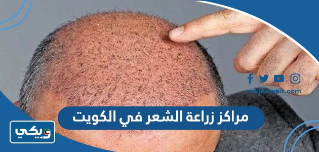 مراكز زراعة الشعر في الكويت