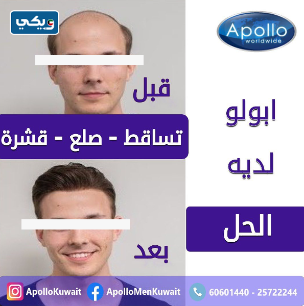 مركز أبولو لزراعة الشعر