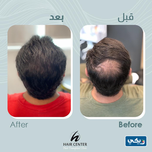 مركز هير سنتر