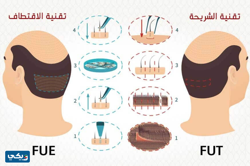 مميزات وعيوب زراعة الشعر في الكويت