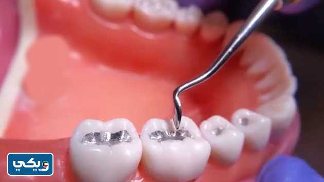 أسعار حشو الأسنان في الكويت 2023