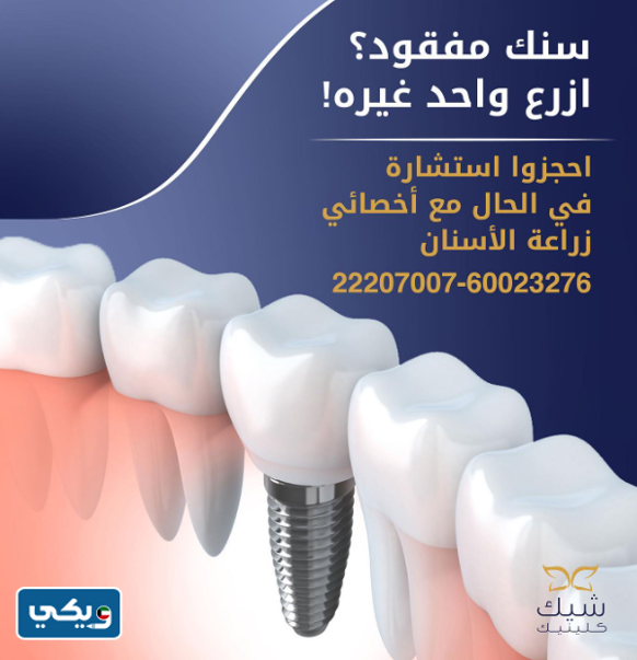 أسعار زراعة الأسنان في شيك كلينيك