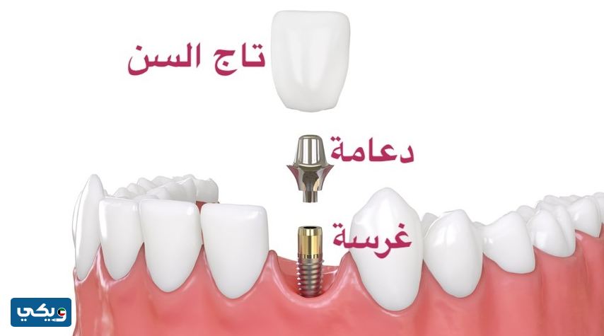 أنواع زراعة الأسنان من حيث نوع الغرسة