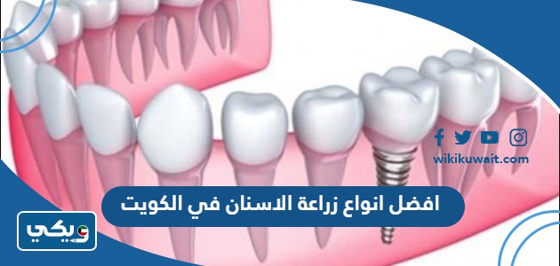 افضل انواع زراعة الاسنان في الكويت