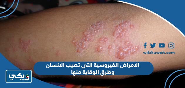 الامراض الفيروسية التي تصيب الانسان وطرق الوقاية منها