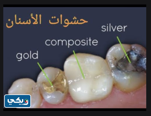 انواع حشوات الاسنان في الكويت 2023