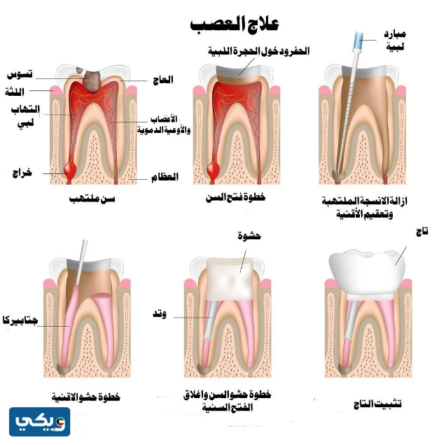 كم عدد جلسات حشو العصب