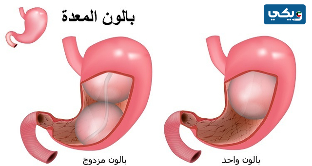 عملية البالون مستشفى السلام