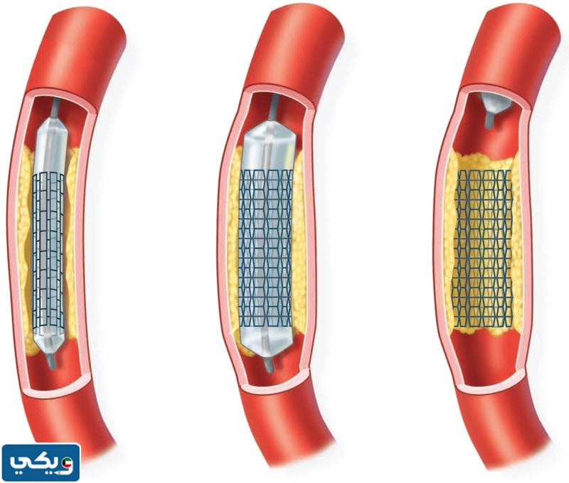 سعر دعامة القلب في الكويت