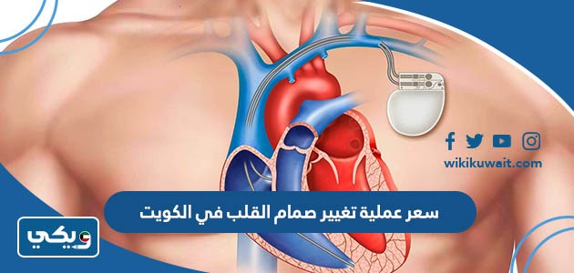 سعر عملية تغيير صمام القلب في الكويت