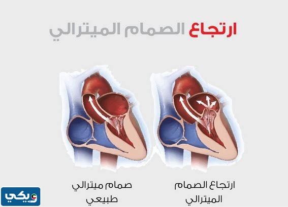 سعر عملية تغيير صمام القلب في الكويت