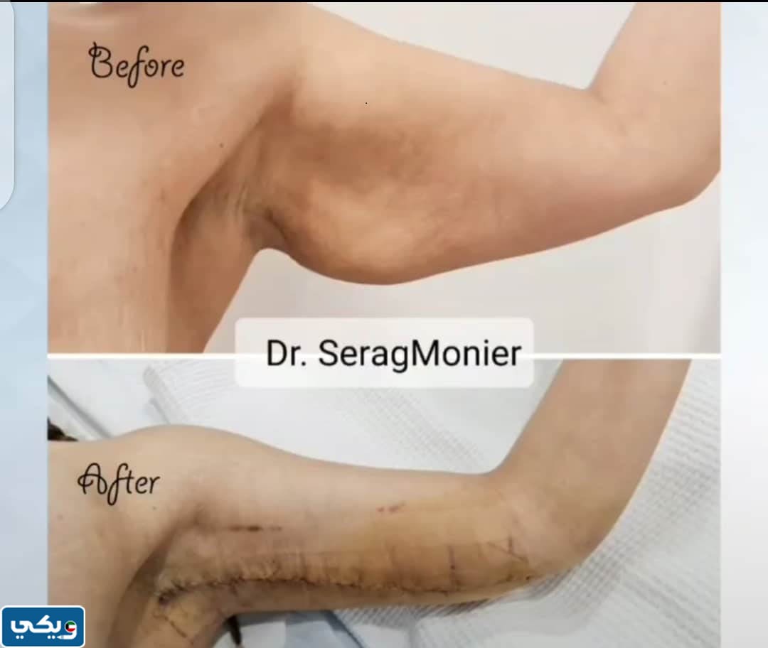 تجربتي مع  الدكتور سراج منير