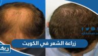 زراعة الشعر في الكويت 2025 (المميزات، الاسعار، العيادات) زراعة الشعر في الكويت 2025 (المميزات، الاسعار، العيادات)