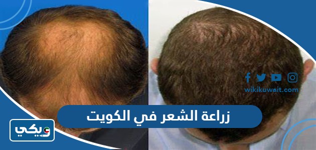 زراعة الشعر في الكويت
