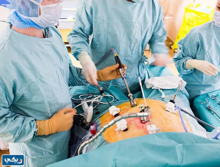 كم أسعار عملية التكميم عند الدكتور خالد العنزي 2024