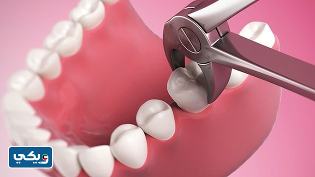 كم سعر خلع الضرس في الكويت 2024