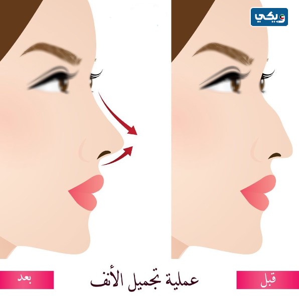 كم أسعار عمليات تجميل الأنف في الكويت 2024